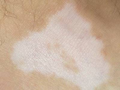 成都治白癜风哪家医院服务较好?白癜风症状有什么